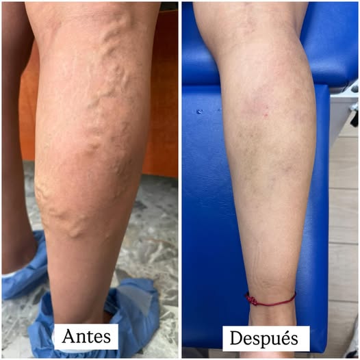 Calcetas Essenza de Compresión de 20-30mmHg